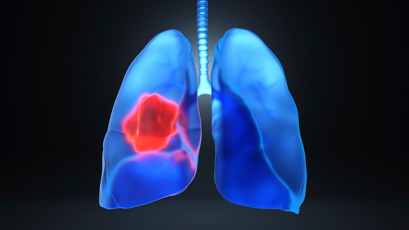 Image of lungs
