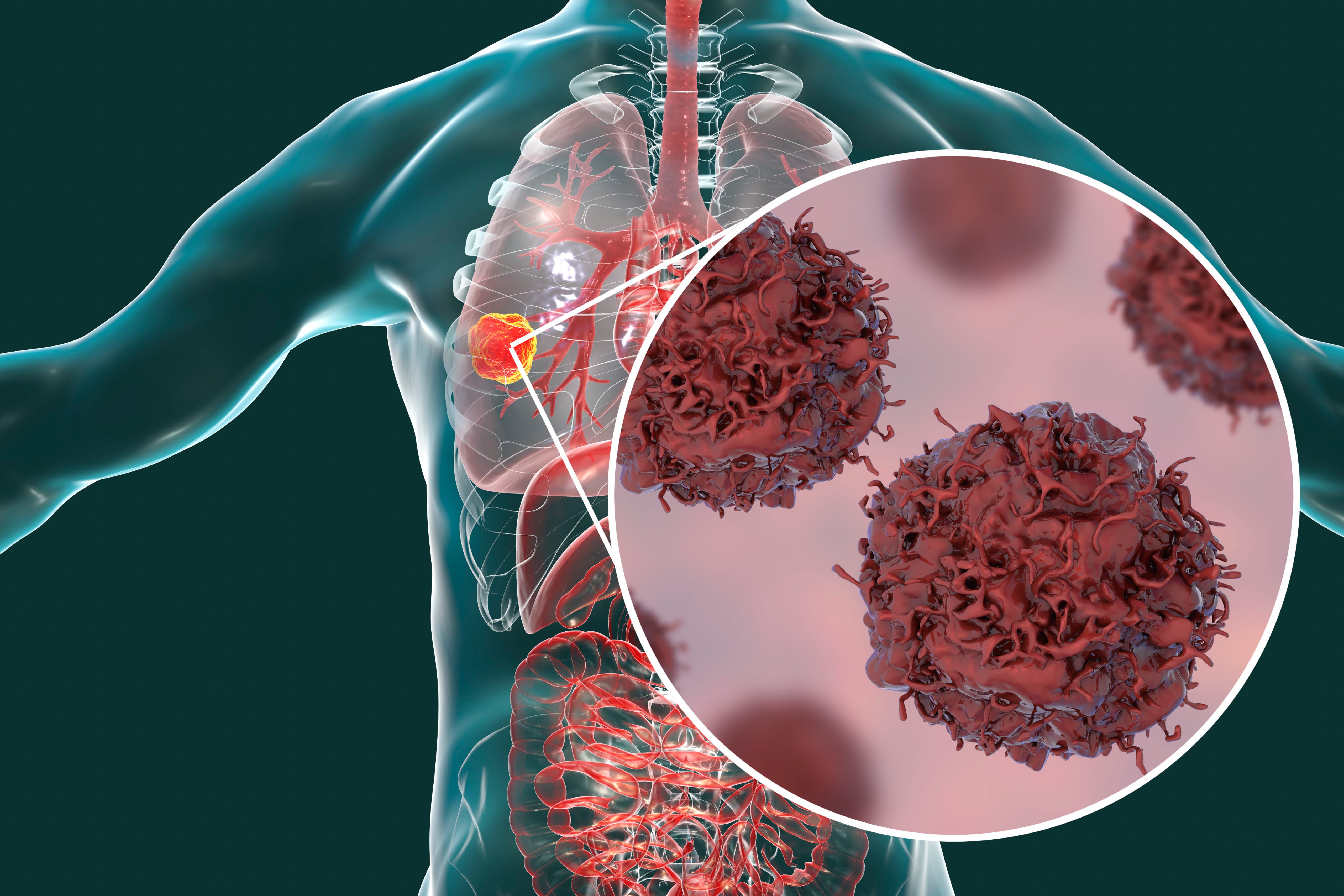 Lung cancer tumor cells 