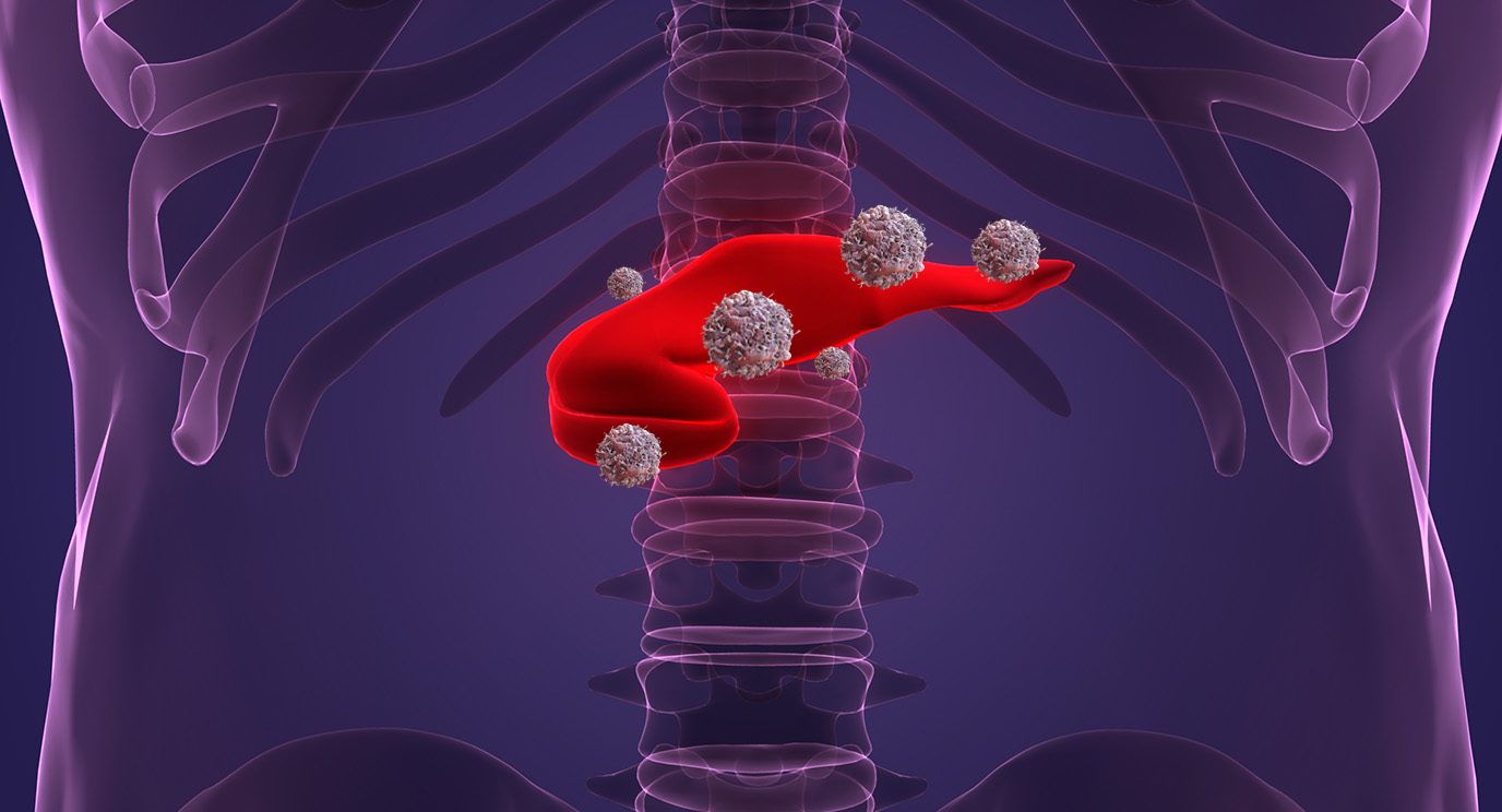 Pancreas with cancer cells