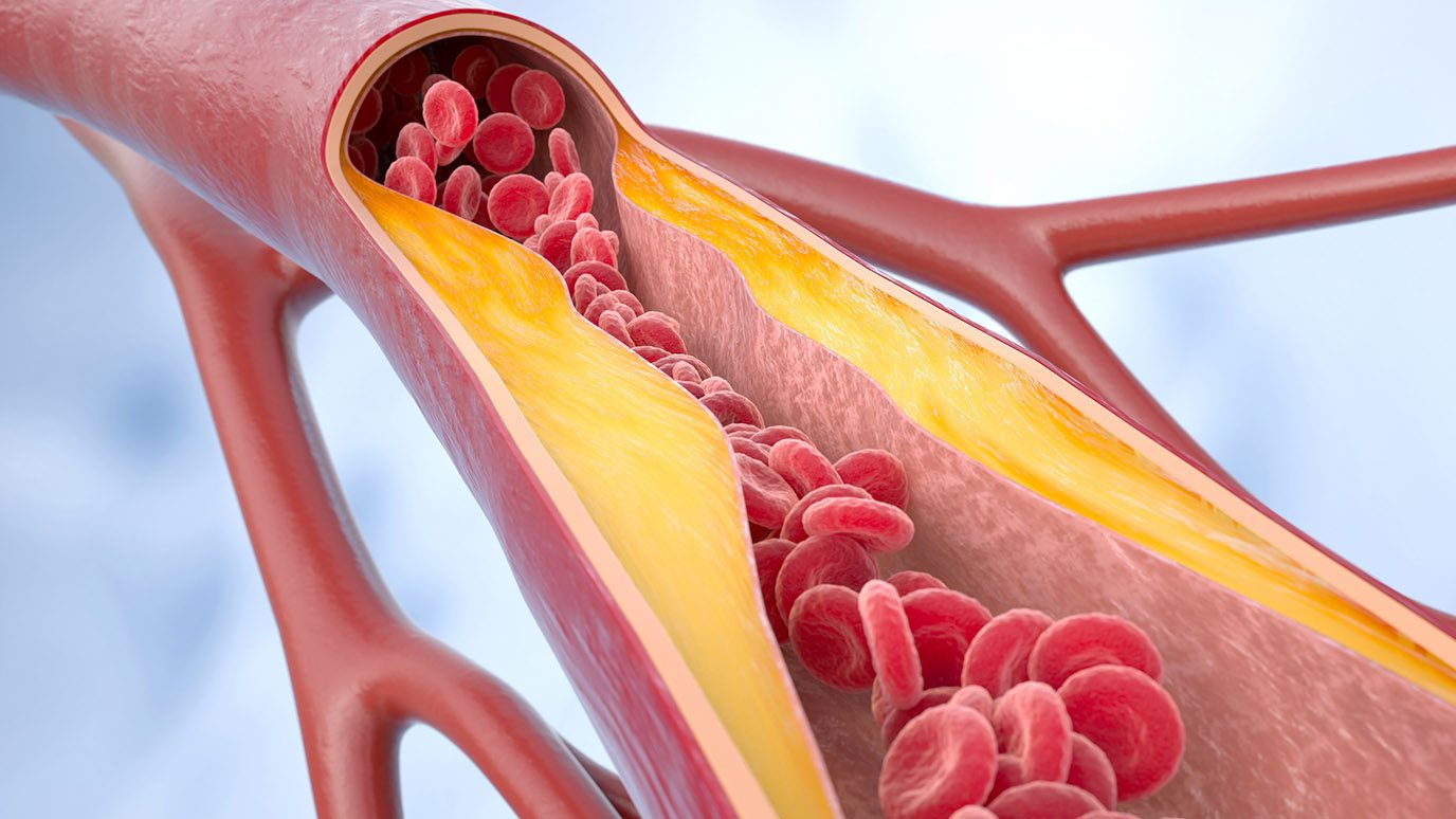 Image of clogged blood vessel filled with plaques