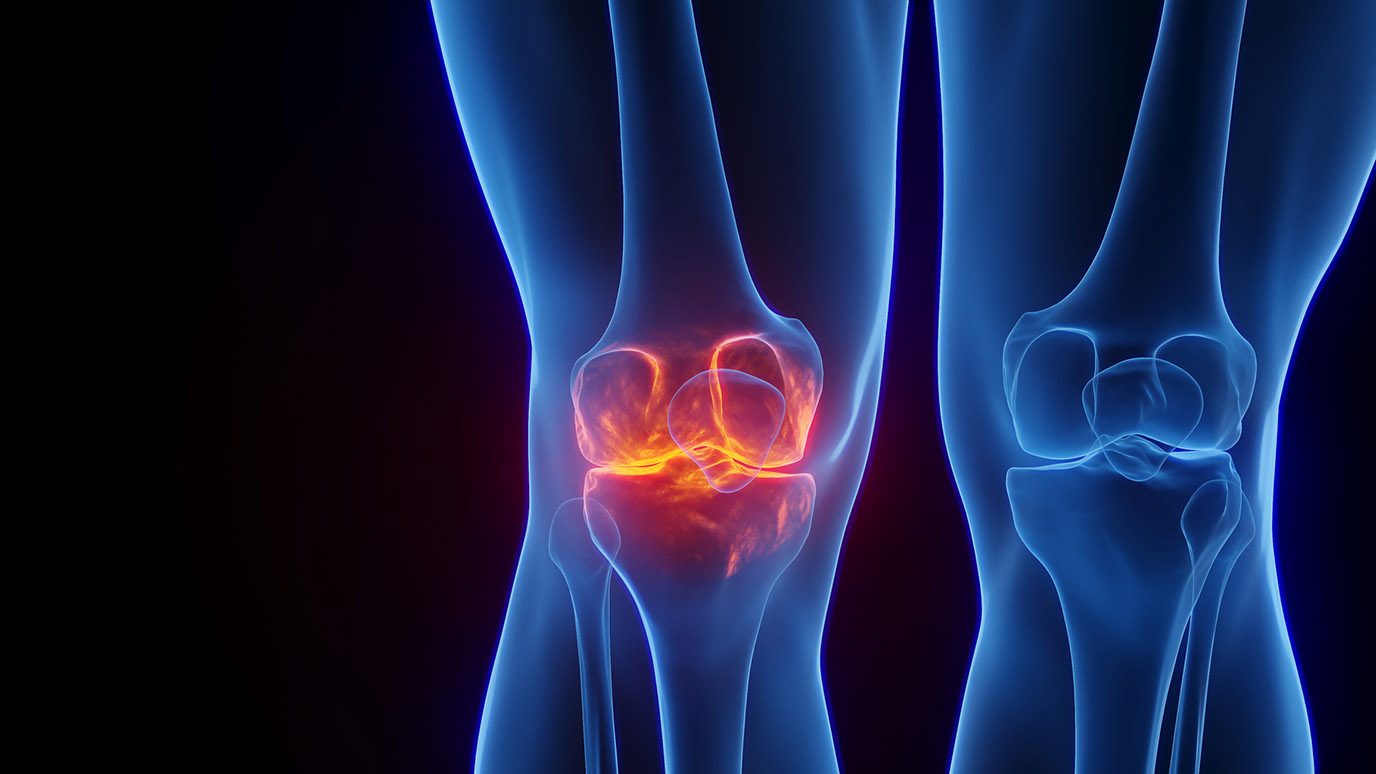 A digital illustration depicting inflammation in a knee joint.