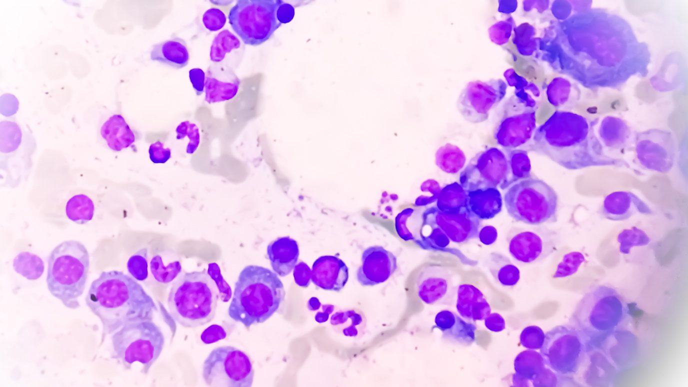 Microscopic view of bone marrow slide showing multiple myeloma