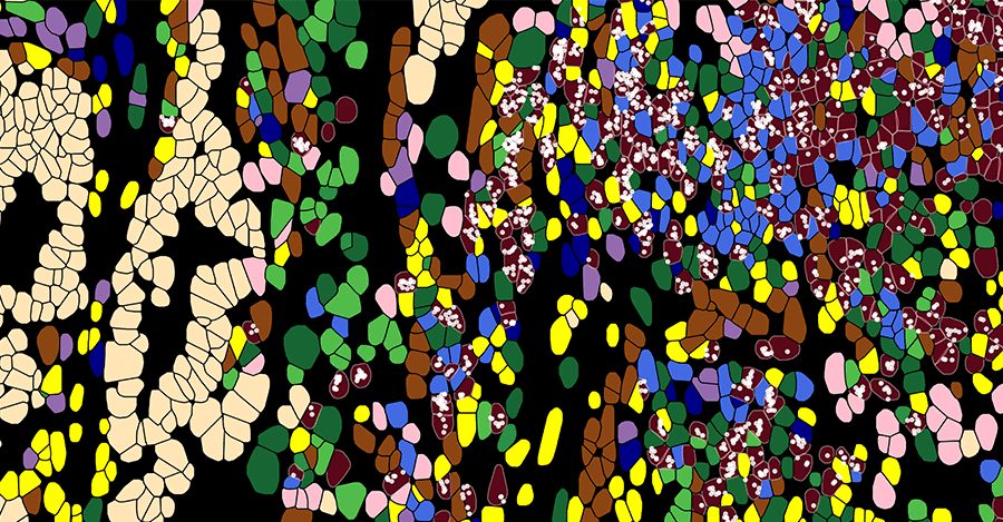 High-resolution spatial profiling image showing stressed T cells within the tumor microenvironment. In the image, tumor cells are shown in tan, fibroblasts in yellow, and T cells in wine color. T cells in stress response state are marked with white dots. The number of white dots within each cell denotes the abundance of the heat shock gene transcript, HSPA1A, a marker of stressed T cells. B cells are depicted in blue, plasma cells in navy, macrophages in green and pine, epithelial cells in pink, mast cells in violet, and endothelial cells in brown. 