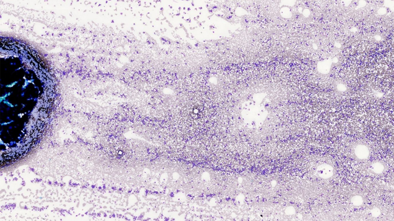 Bone marrow image of patient with AML. Image courtesy of Wei Ying Jen, M.D.
