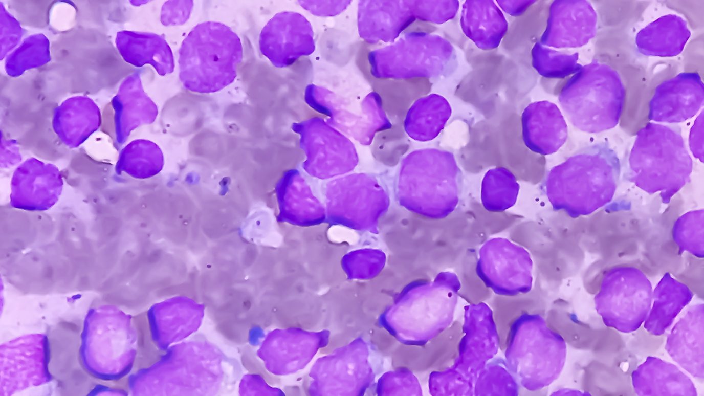 leukemia cells in microscope close-up