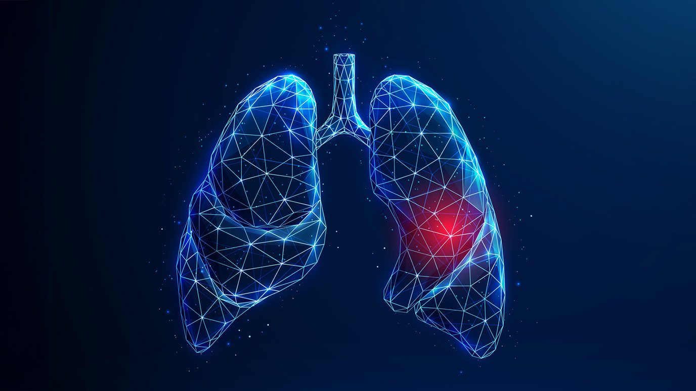 Image of lungs with red highlight showing cancer