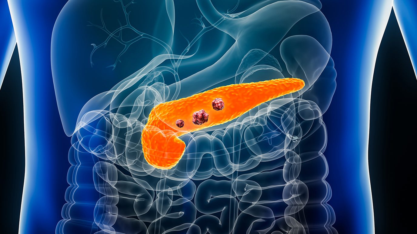 Pancreas with cancer cells