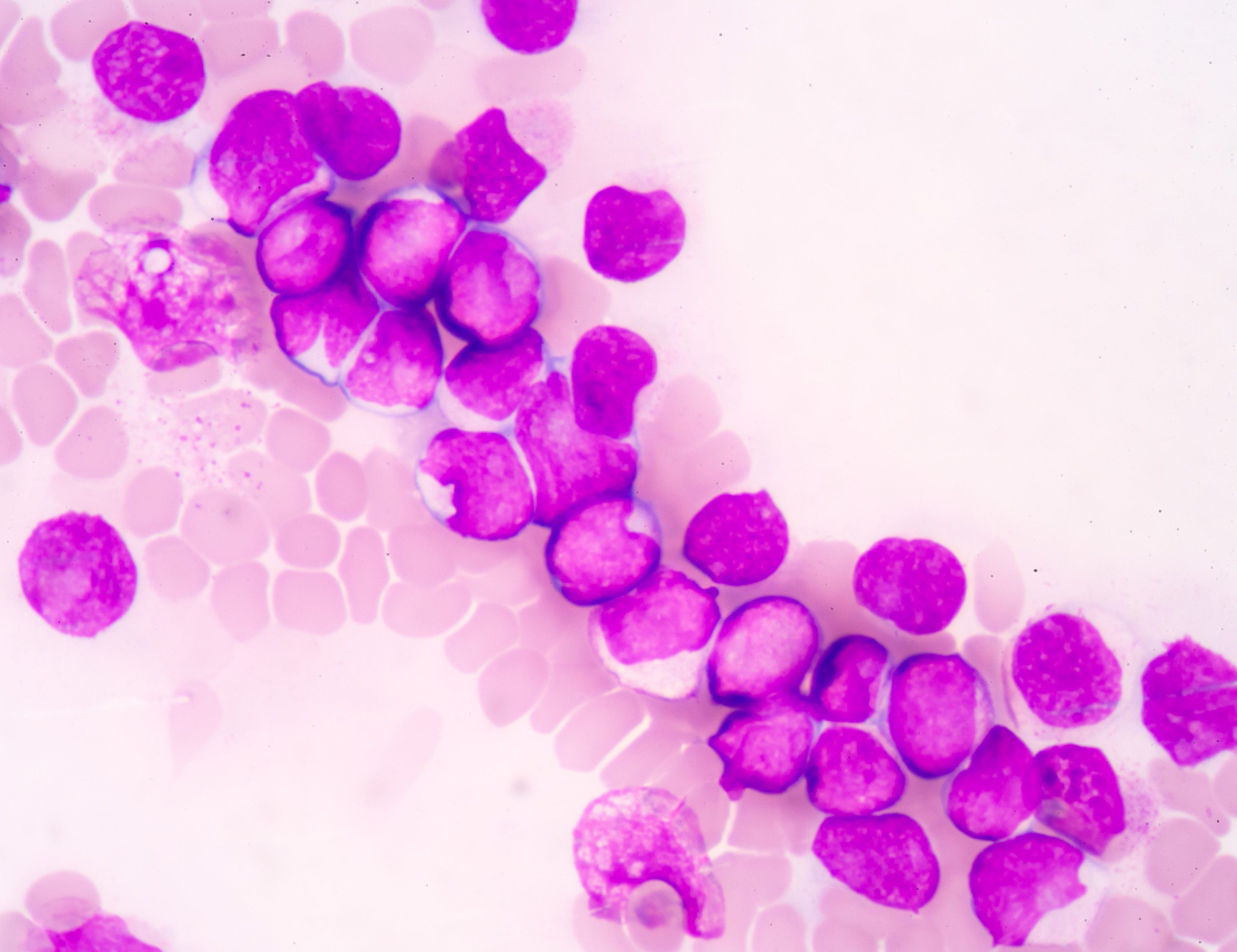AML cells