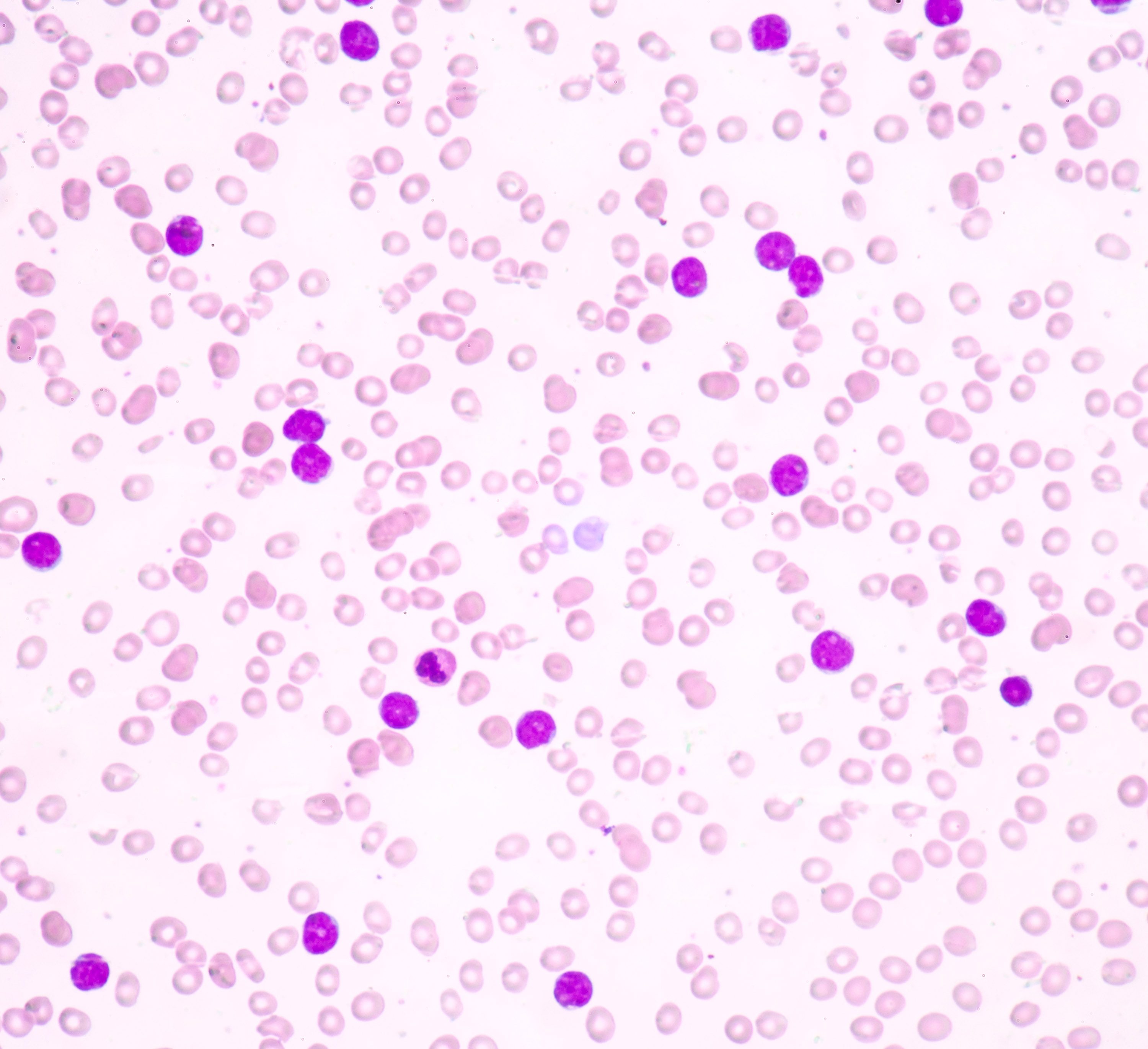 Leukemia cells