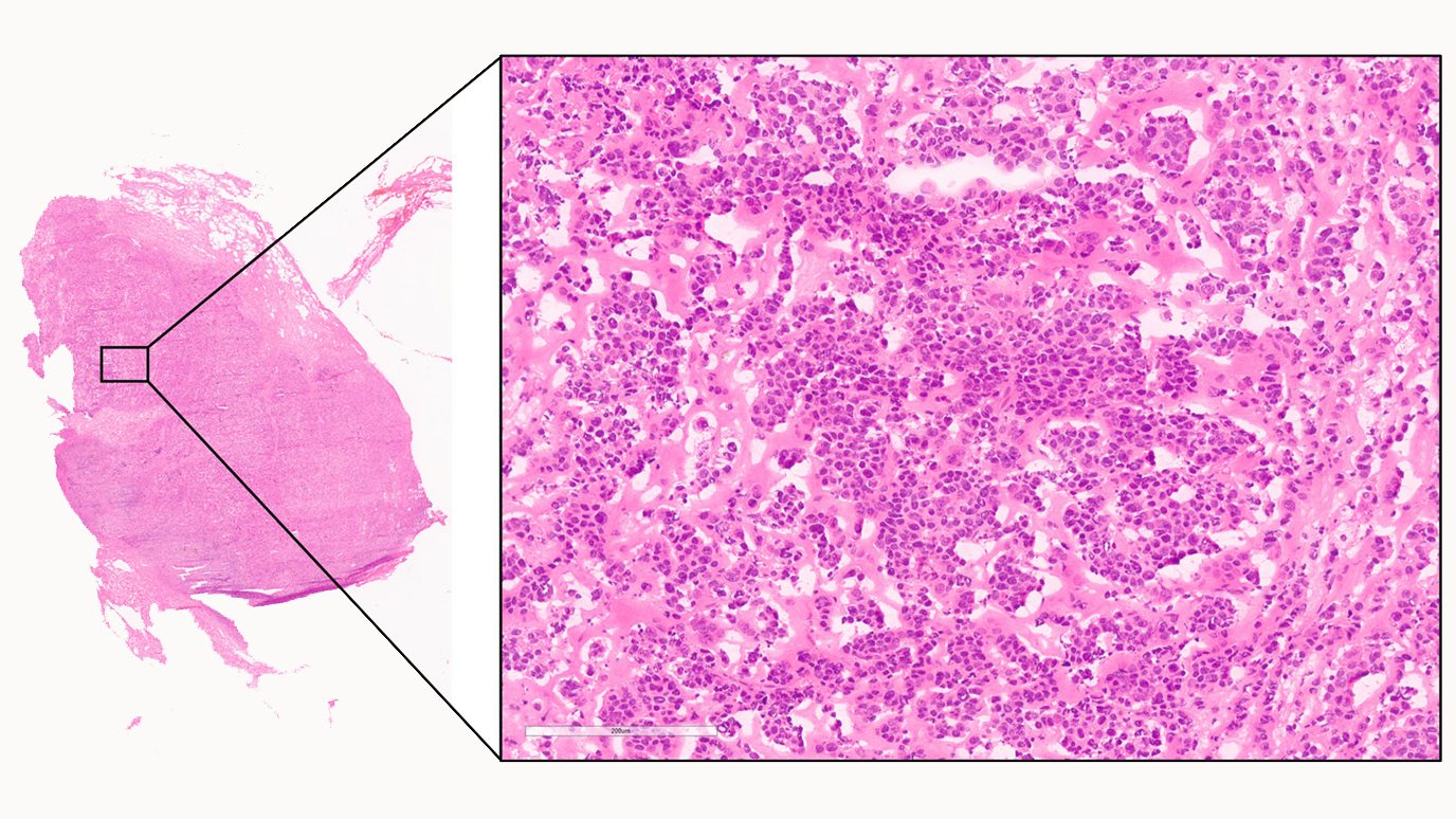Whole slide digital image of stained frozen section of lymph node showing metastatic carcinoma that was obtained at the time of surgery from a patient with breast cancer status post neoadjuvant chemotherapy. Image courtesy of Savitri Krishnamurthy, M.D.