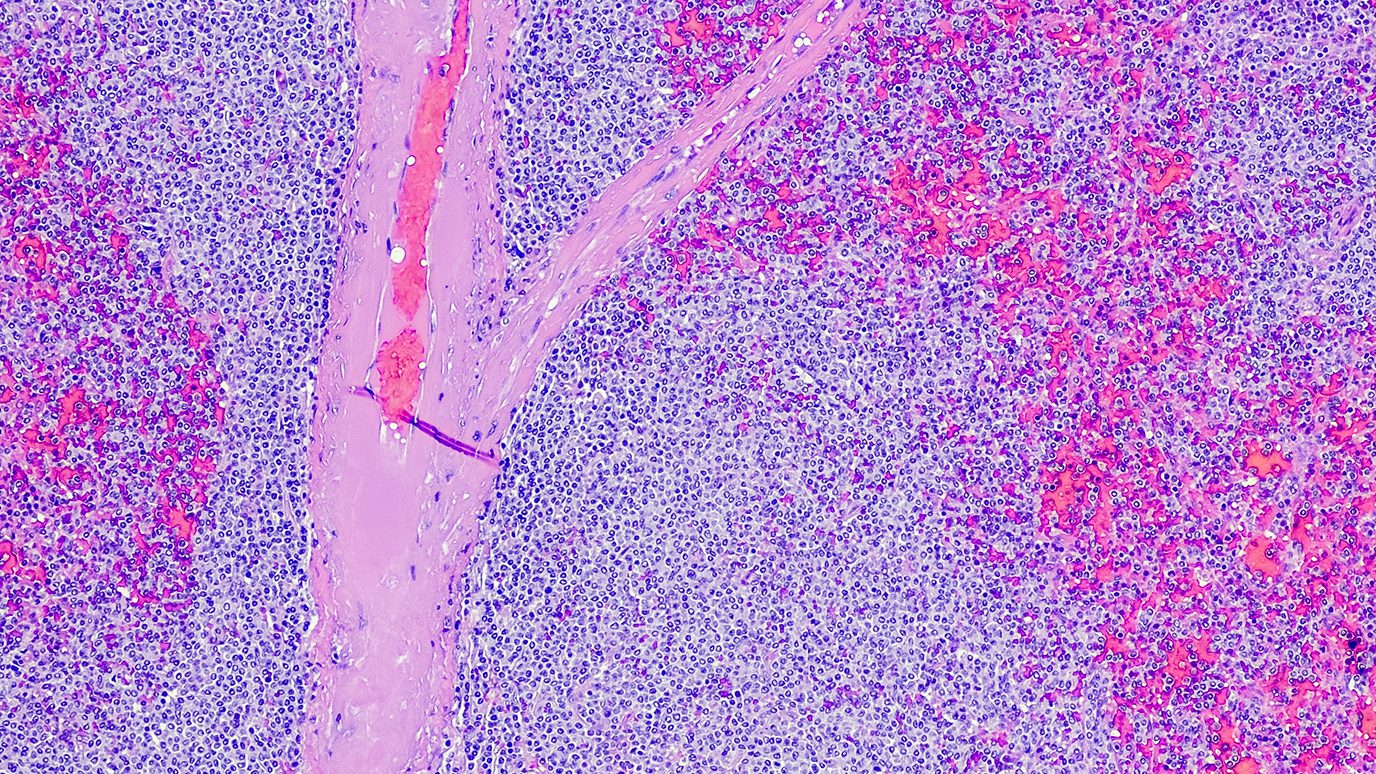 Image of Mantle Cell Lymphoma 