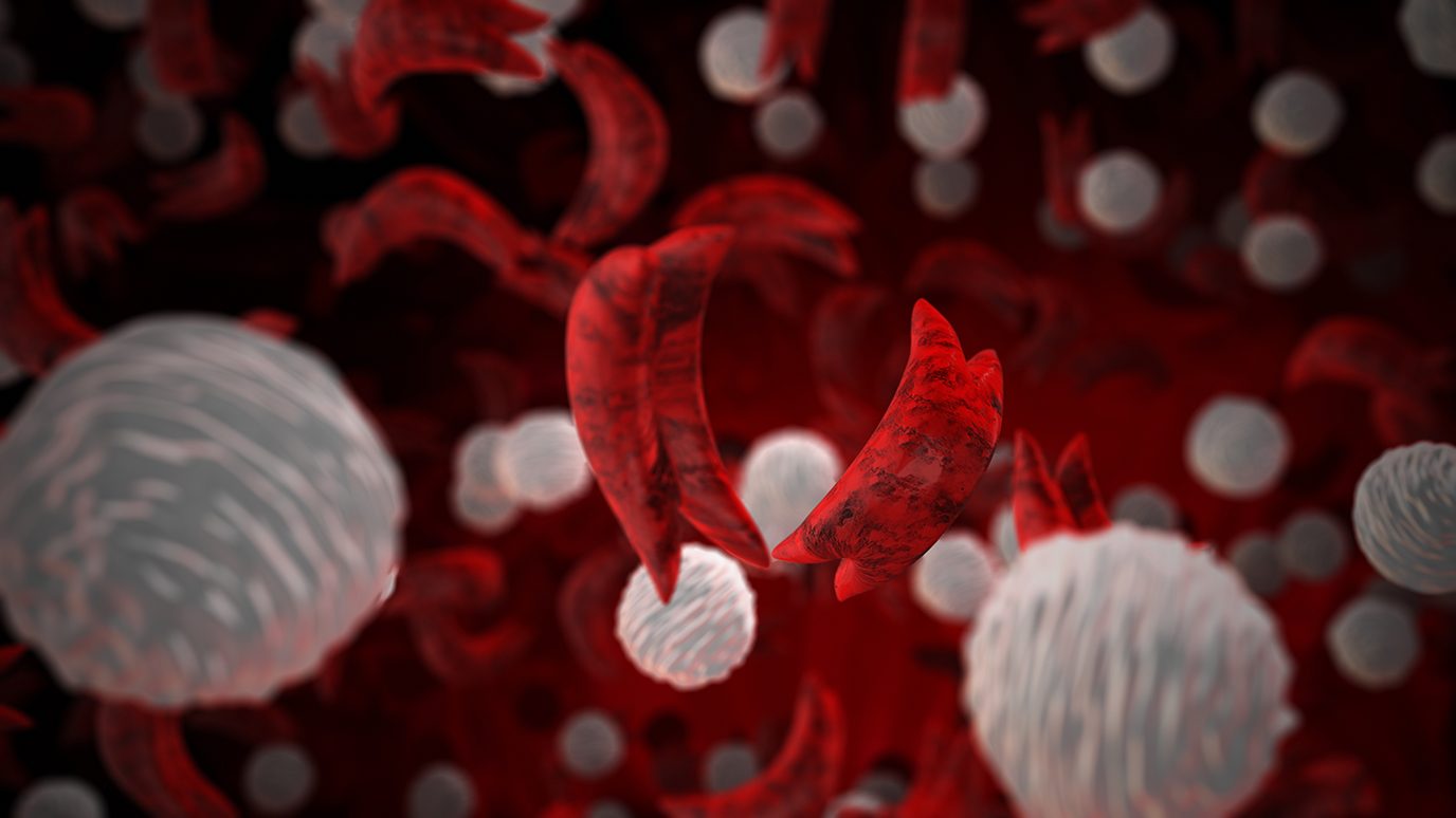sickle cell with white blood cells