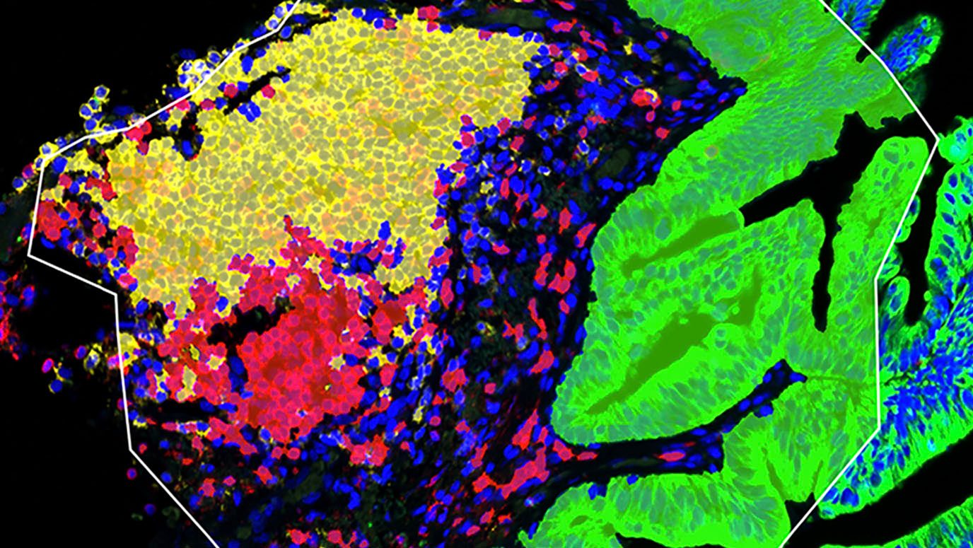 Region of early-stage lung cancer showing cancer cells (green) and tumor-infiltrating B cells (yellow) and T cells (red). Cell nuclei are shown in blue. Image courtesy Linghua Wang, M.D., Ph.D.