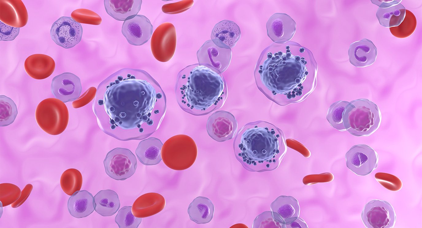 Illustration of acute myeloid leukemia cells with red blood cells.