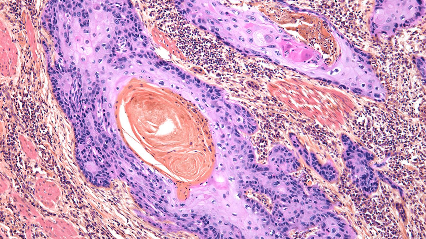 A image of a light micrograph of a section through a squamous carcinoma of the skin. Whorls of enclosed keratin are shown in orange.