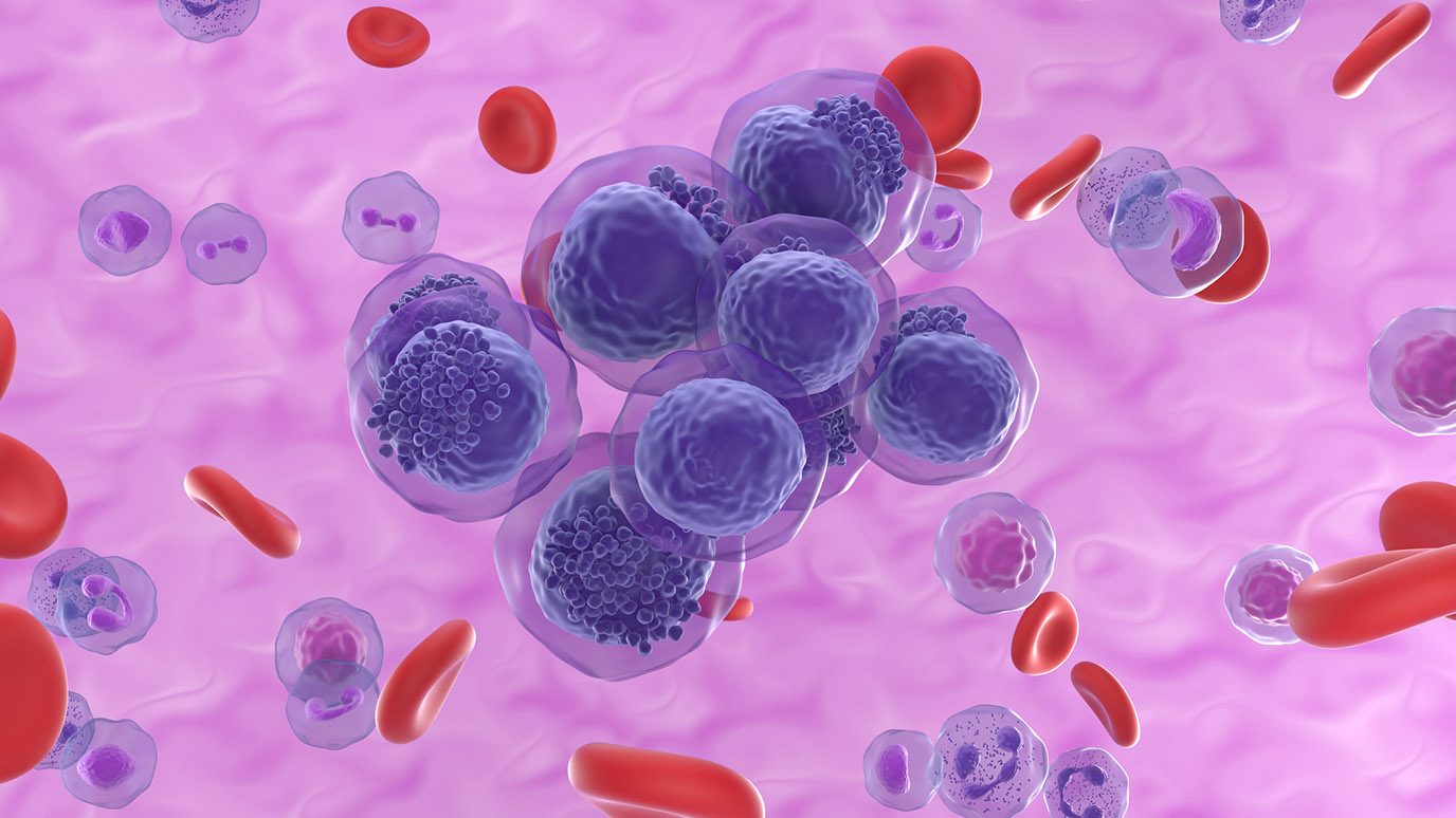 Digital illustration of acute myeloid leukemia (AML) cells mixed with healthy red blood cells.