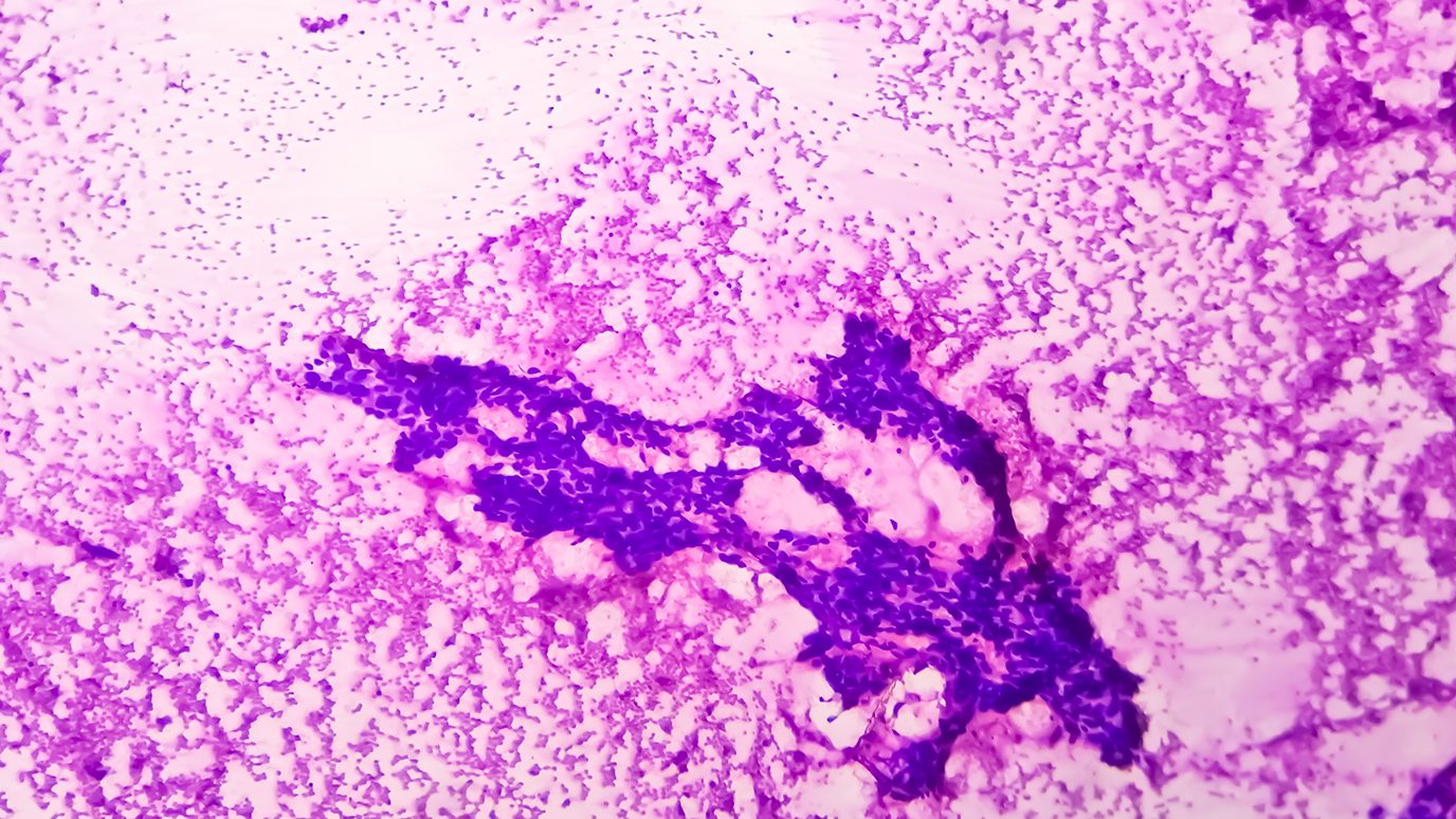 Microscope image of breast cancer