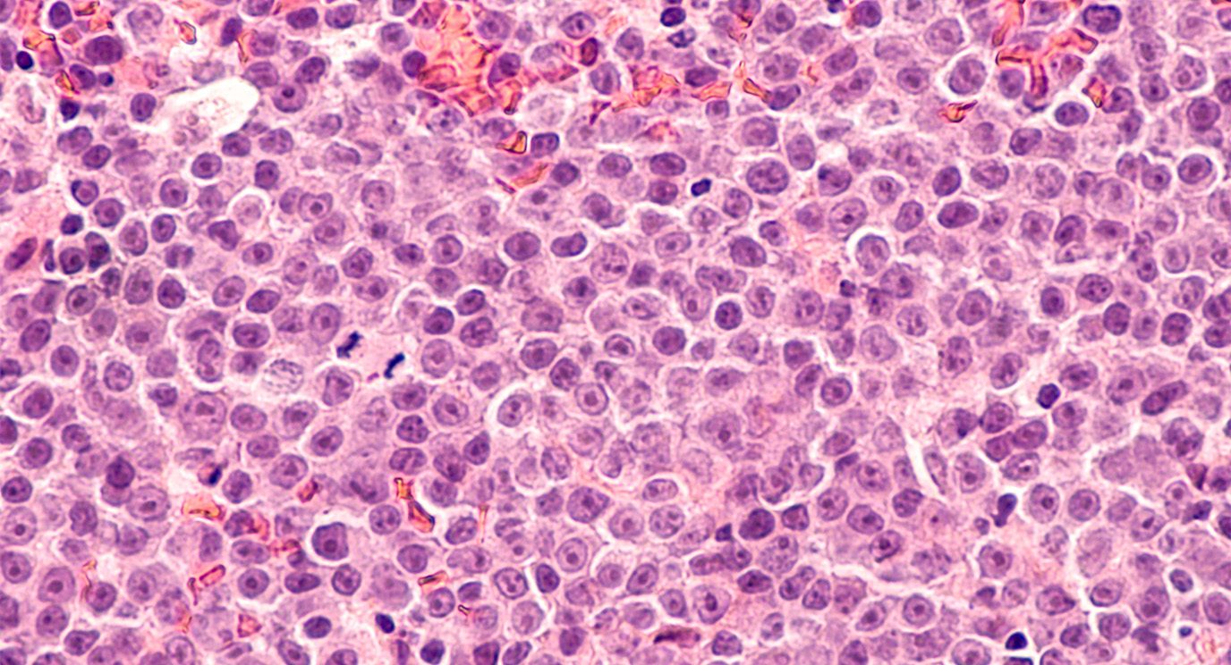 Image of B-cell lymphoma cells