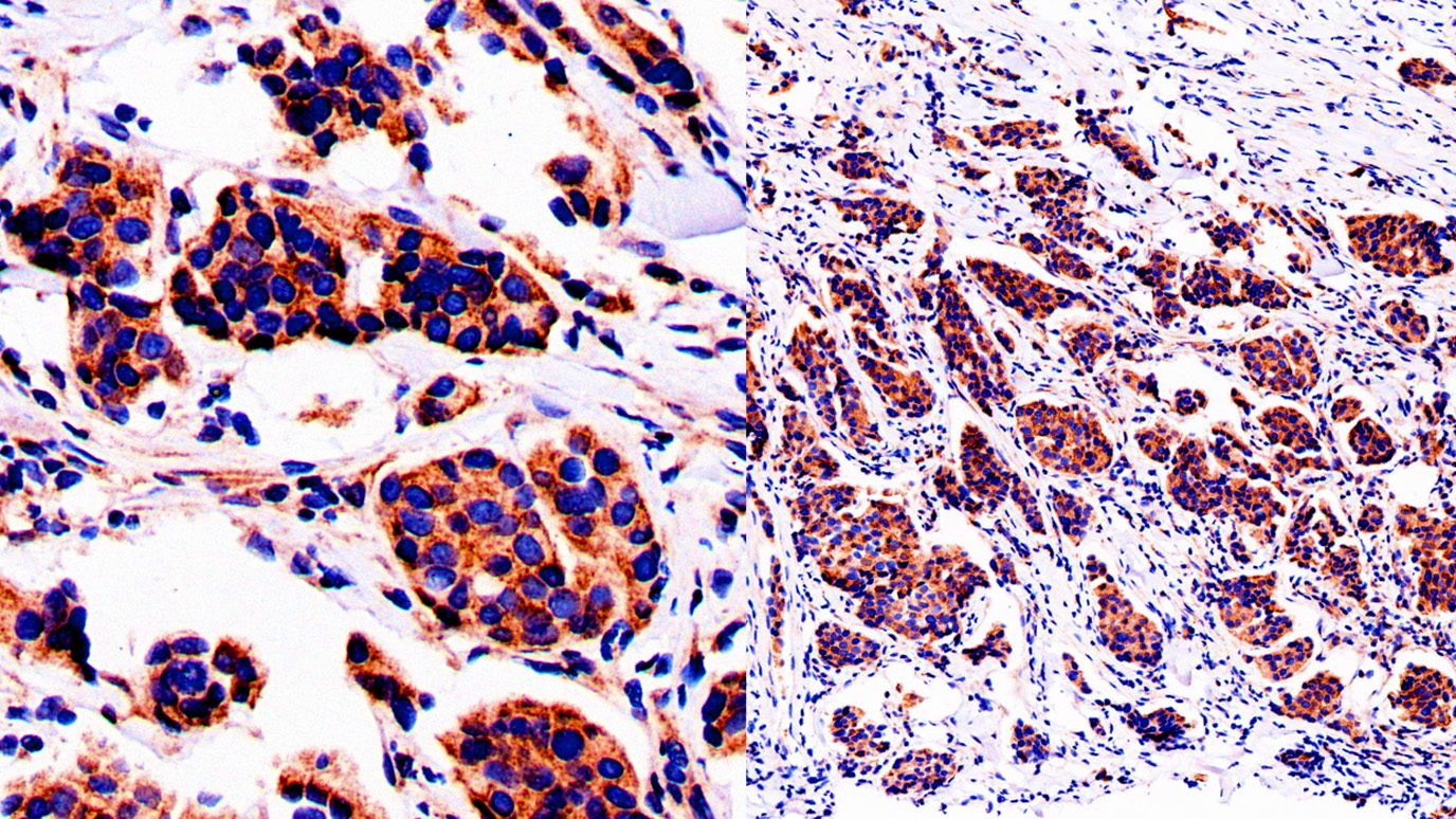 Image (enlarged in left) of a metastatic bone tumor (bone metastasis) from a breast cancer patient showing strong immunohistochemical staining of the ACBP protein (brown). Image courtesy of Li Ma, Ph.D.  