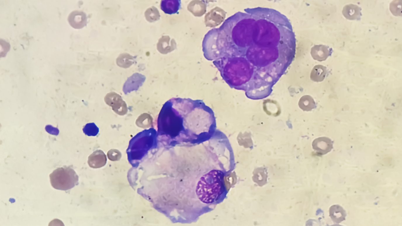 Image of colorectal cancer cells spreading in the abdominal cavity