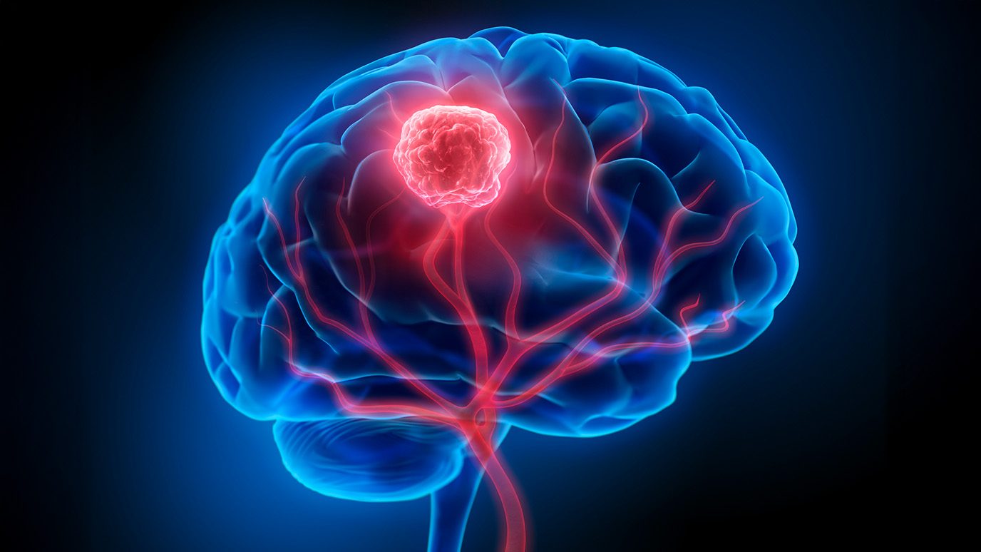 brain with tumor