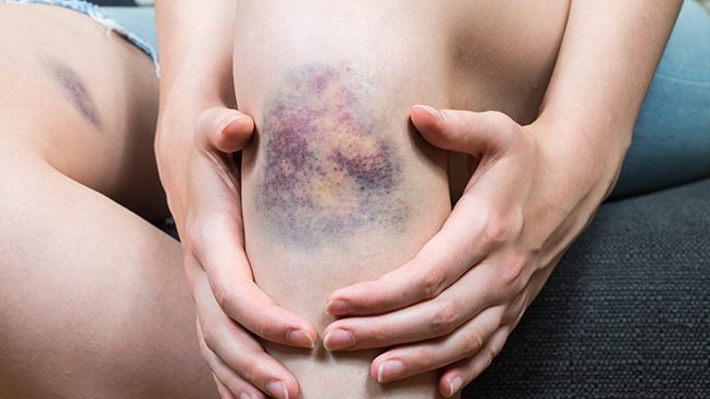 Close up of a multi-colored bruise on someone's knee
