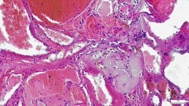 A micrograph of adenoid cystic carcinoma in the breast