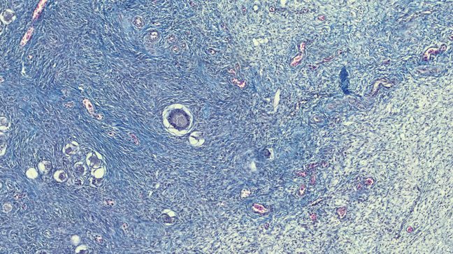 Microscopic view of uterine fibroids, a type of benign tumor