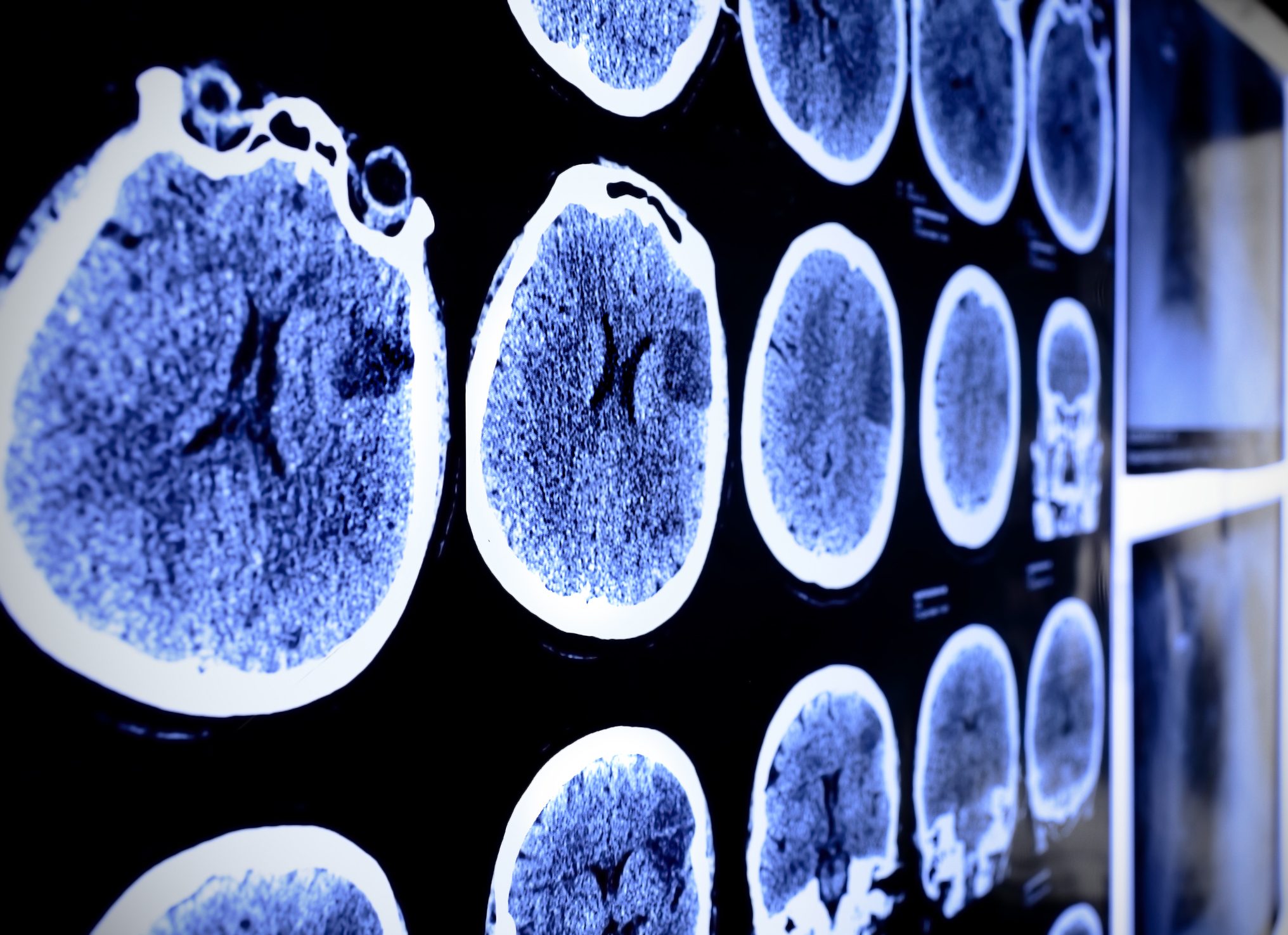 Cancerwise blog post: What to know about brain tumors, brain tumor treatment and clinical trials for brain tumors