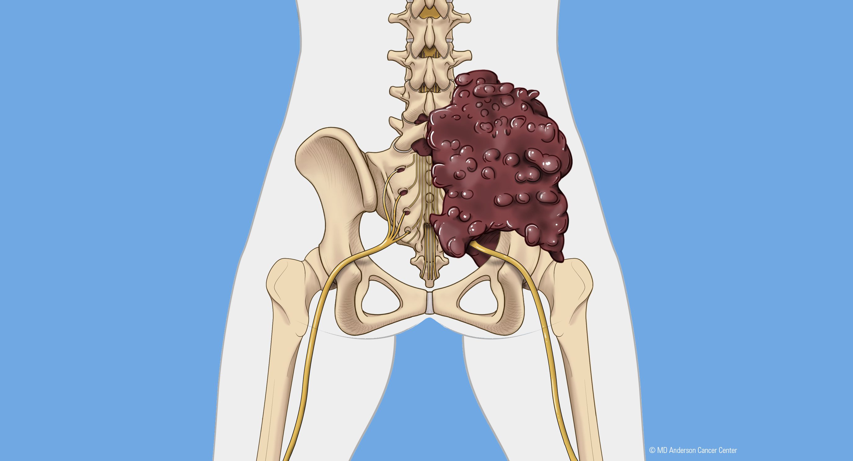 A chondrosarcoma tumor located in the pelvic area (posterior view).