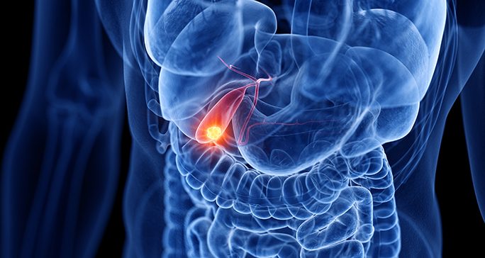 Image of a cancerous tumor located in the gallbladder