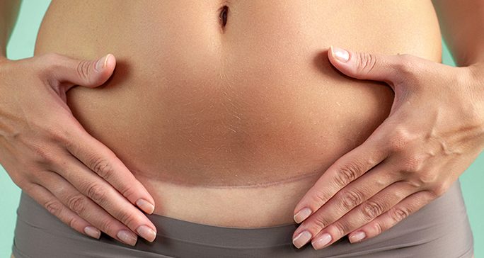 Close-up of fit white woman's belly with well-healed horizontal scar across pubic area