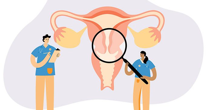 Tiny illustrated doctors examine an oversized cervix with a magnifying glass