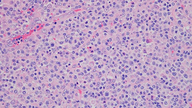 A view of marginal zone lymphoma cells under a microscope