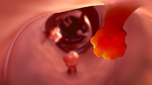 CGI rendering of polyps inside the body