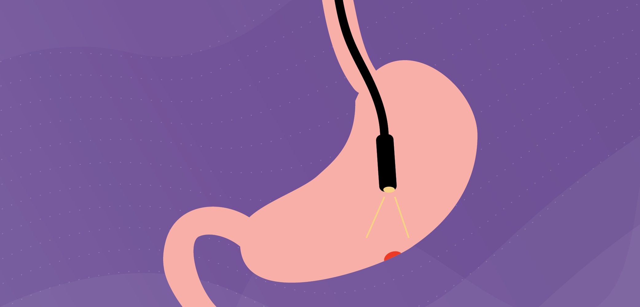 illustration of a stomach with scope looking inside at a polyp